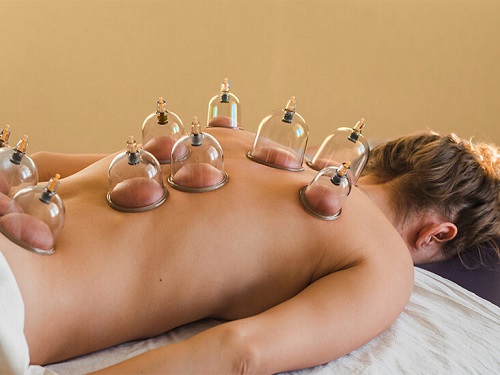 cupping therapy