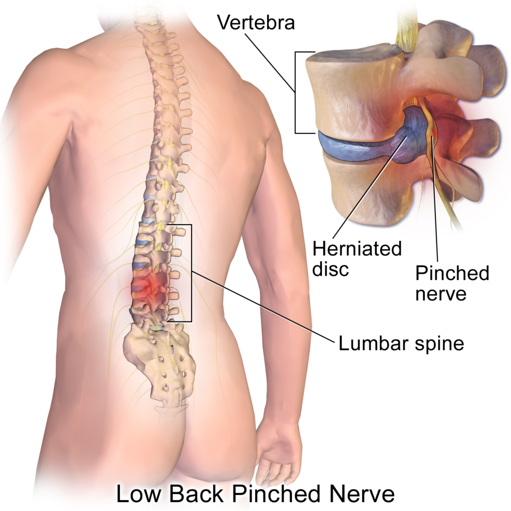 Illustration of a herniated lumbar disc bulging against a spinal nerve root