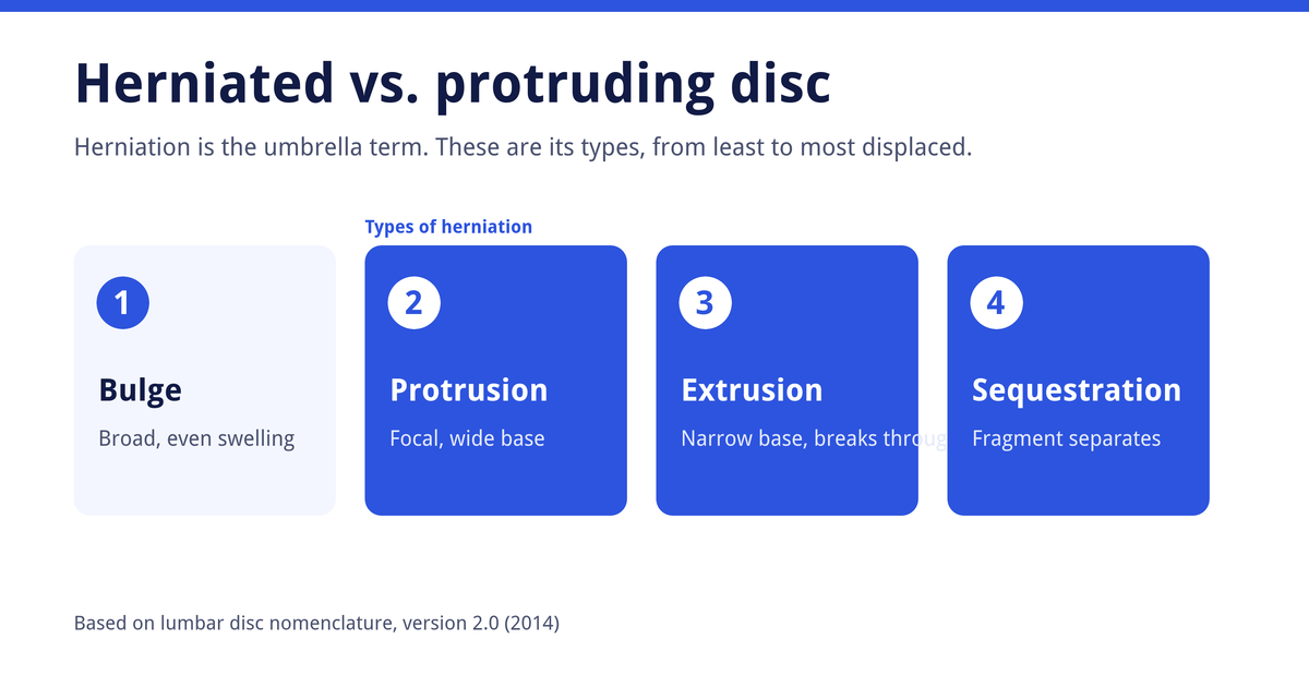 Diagram of four disc terms from least to most displaced: bulge, protrusion, extrusion and sequestration